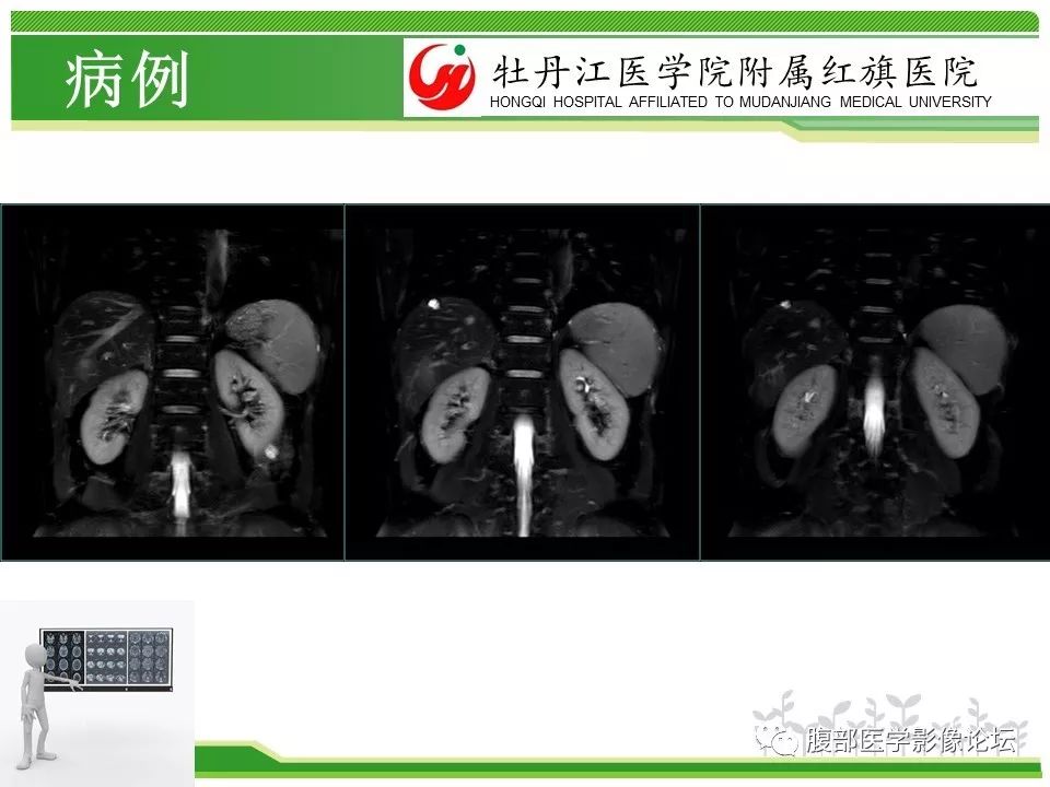 【病例】肝脏局限性慢性炎症1例MR影像