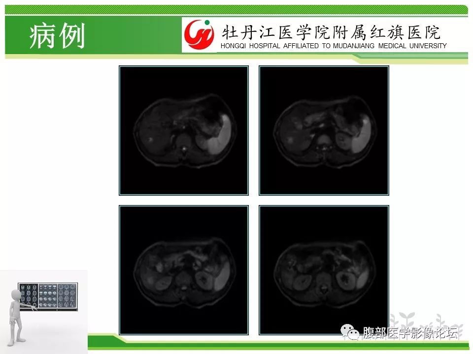 【病例】肝脏局限性慢性炎症1例MR影像