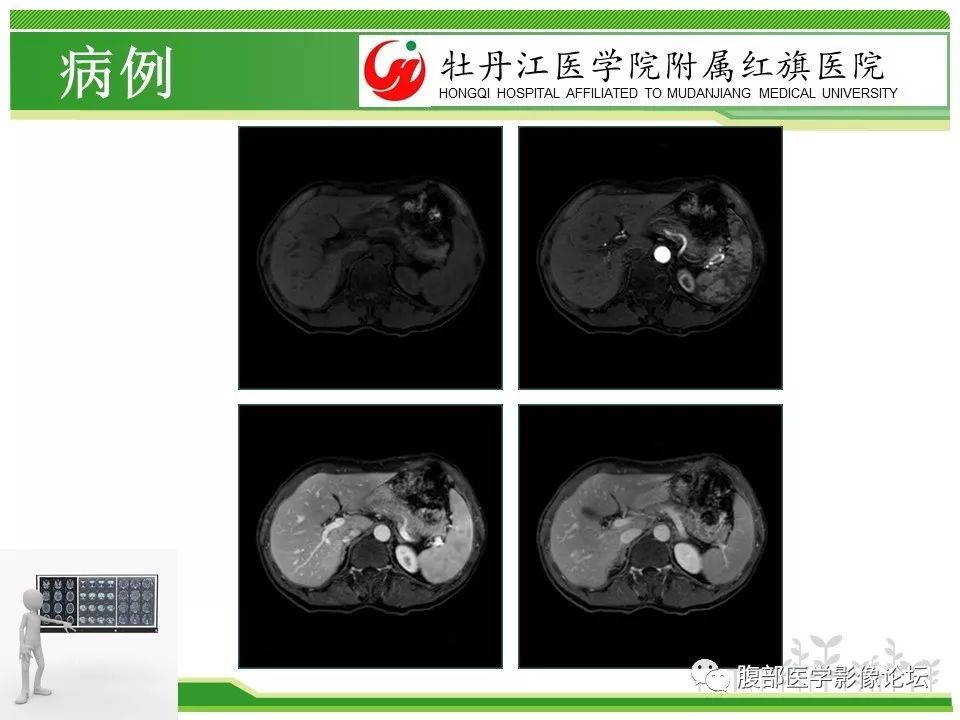 【病例】肝脏局限性慢性炎症1例MR影像