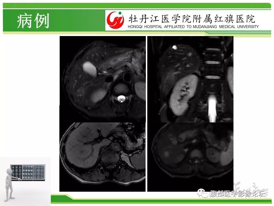 【病例】肝脏局限性慢性炎症1例MR影像
