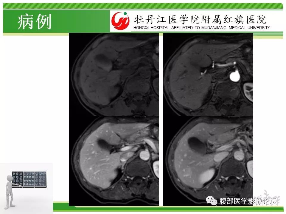 【病例】肝脏局限性慢性炎症1例MR影像