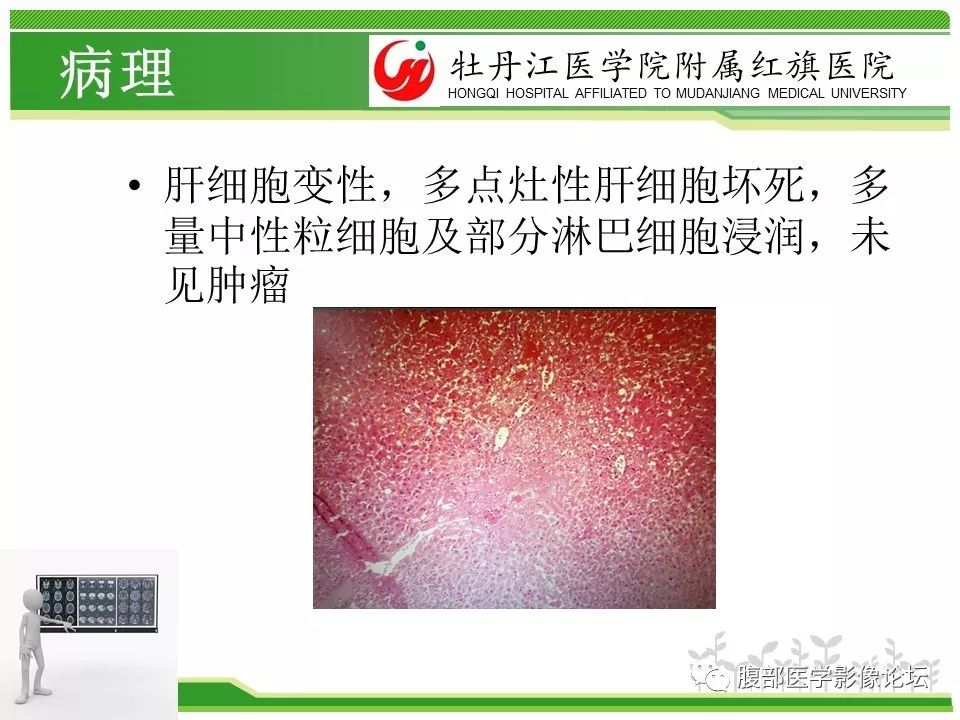 【病例】肝脏局限性慢性炎症1例MR影像