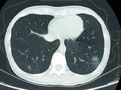 新型冠状病毒肺炎影像病例分析 新型冠状病毒肺炎影像病例分析