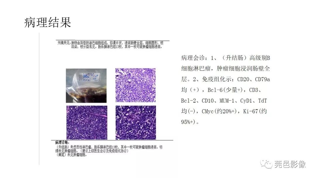 【PPT】肠道淋巴瘤CT诊断