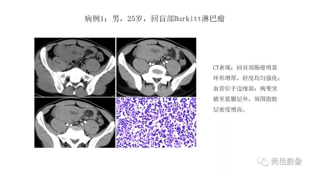 【PPT】肠道淋巴瘤CT诊断