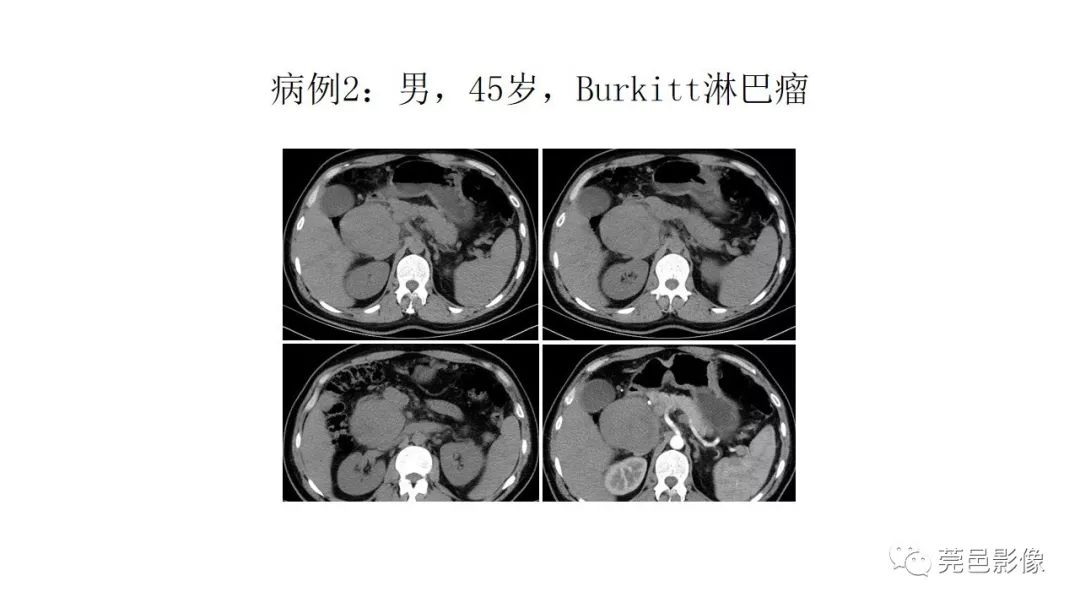 【PPT】肠道淋巴瘤CT诊断