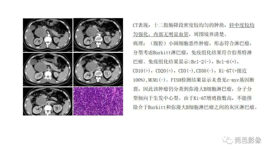 【PPT】肠道淋巴瘤CT诊断