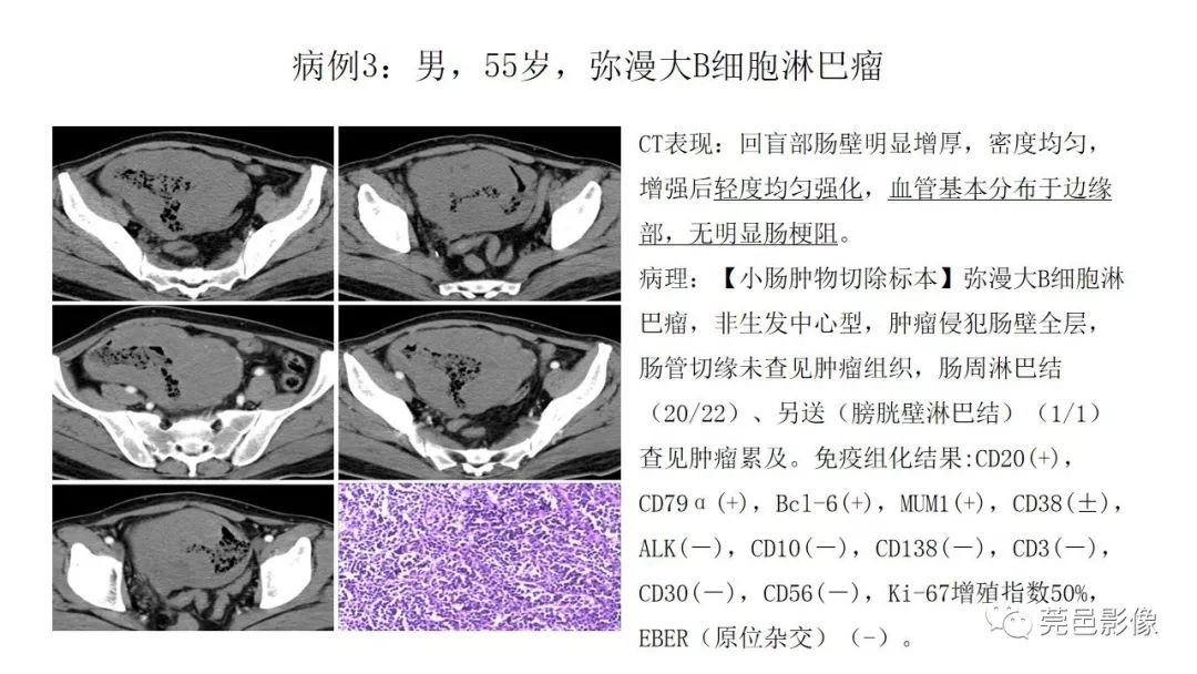 【PPT】肠道淋巴瘤CT诊断