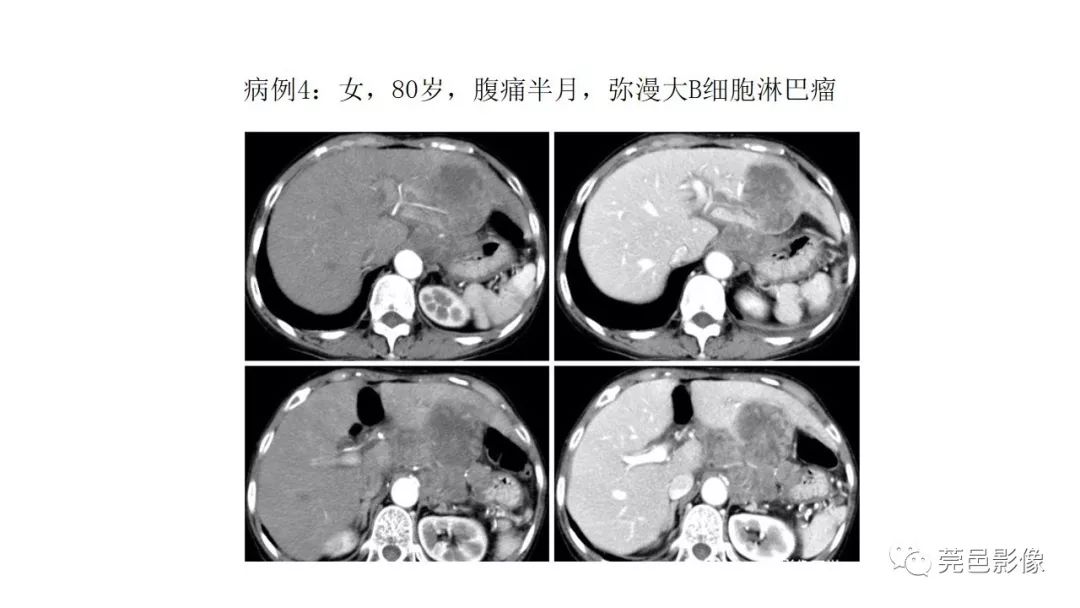 【PPT】肠道淋巴瘤CT诊断