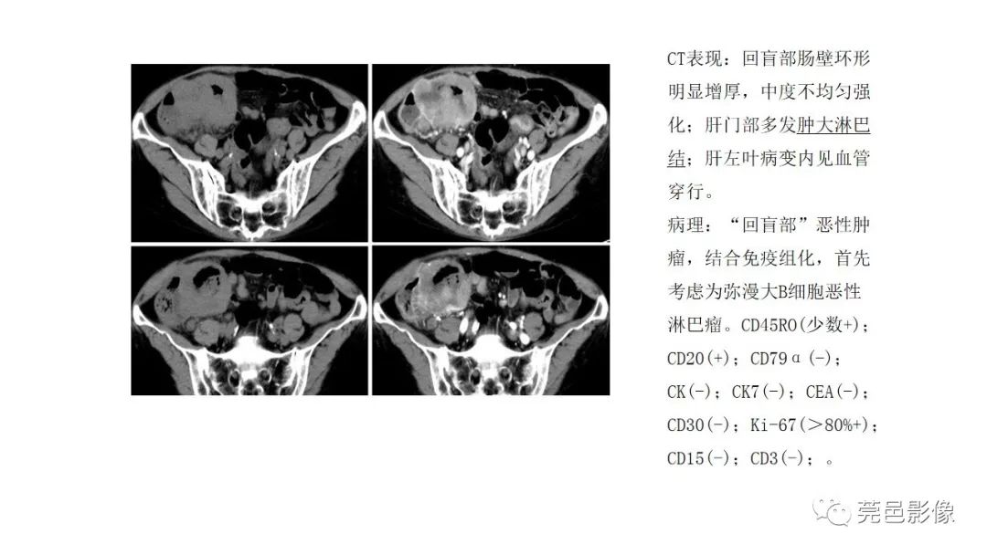 【PPT】肠道淋巴瘤CT诊断
