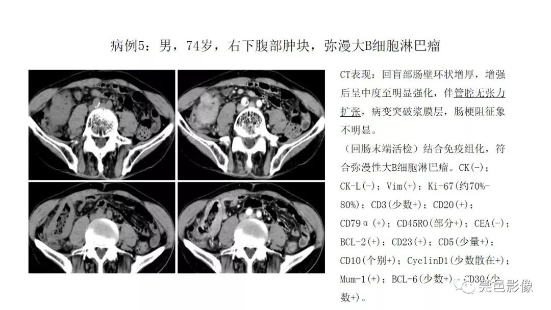 【PPT】肠道淋巴瘤CT诊断