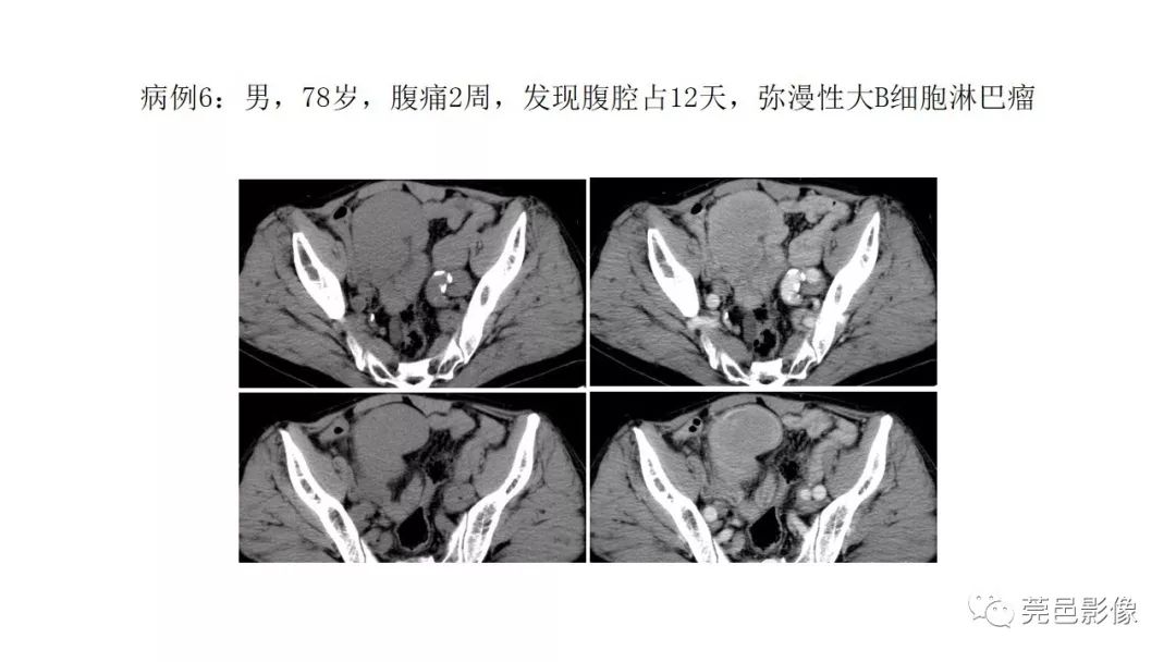 【PPT】肠道淋巴瘤CT诊断