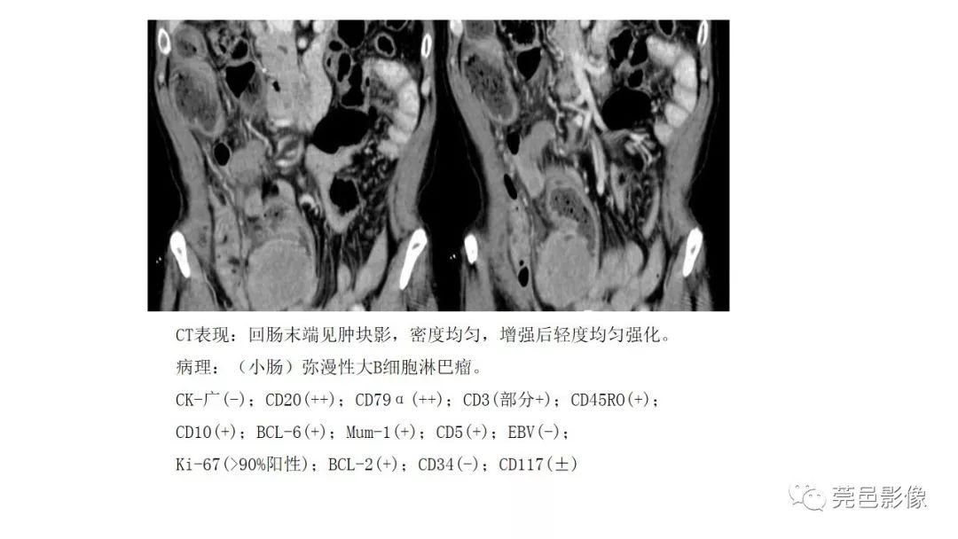 【PPT】肠道淋巴瘤CT诊断