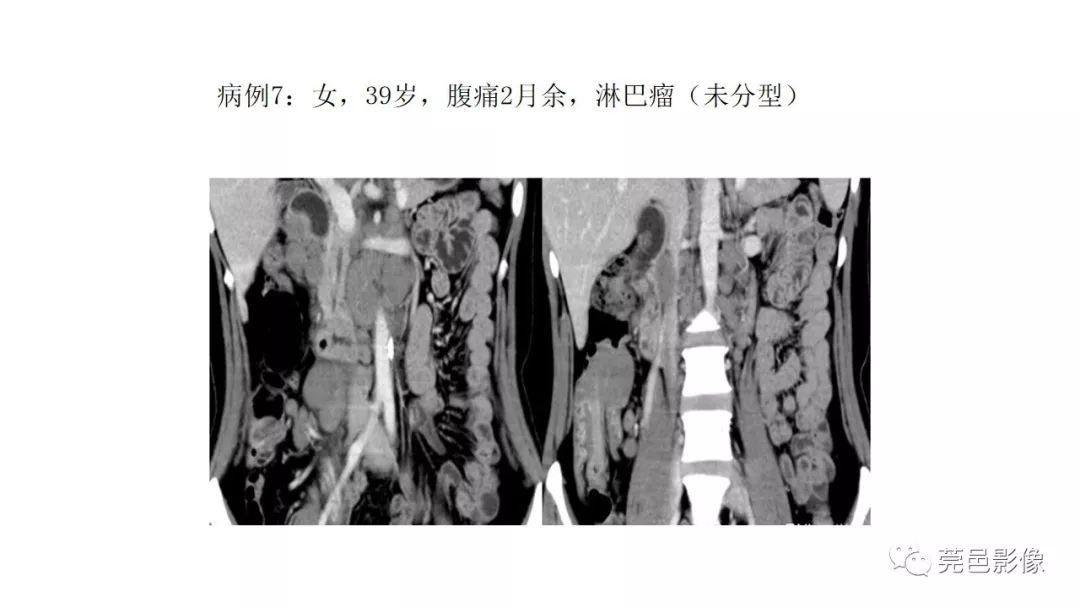 【PPT】肠道淋巴瘤CT诊断