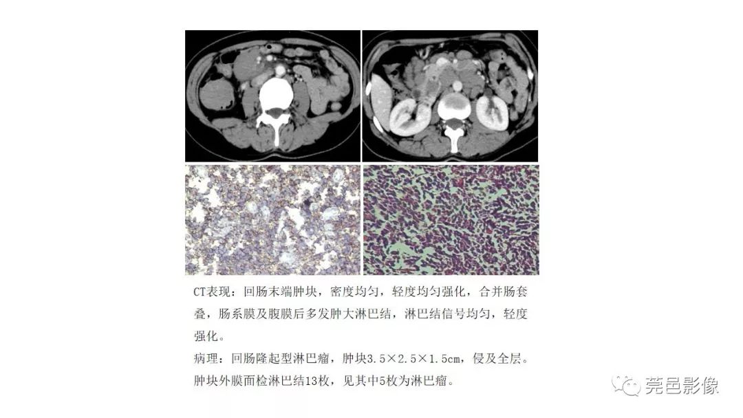 【PPT】肠道淋巴瘤CT诊断