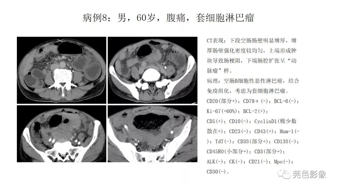 【PPT】肠道淋巴瘤CT诊断