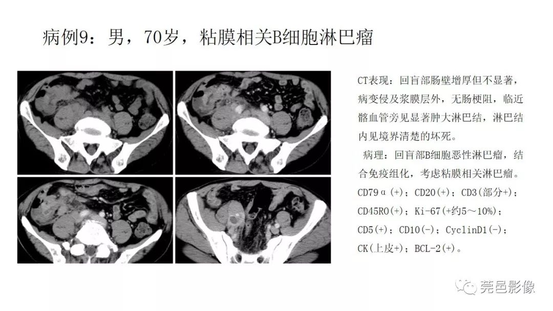 【PPT】肠道淋巴瘤CT诊断