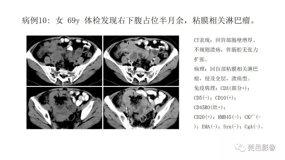 【PPT】肠道淋巴瘤CT诊断