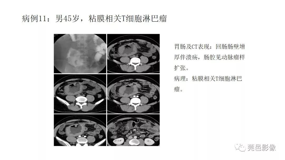 【PPT】肠道淋巴瘤CT诊断