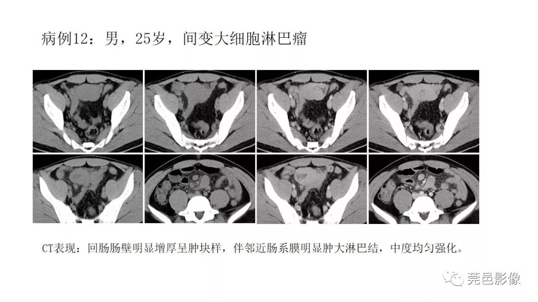 【PPT】肠道淋巴瘤CT诊断