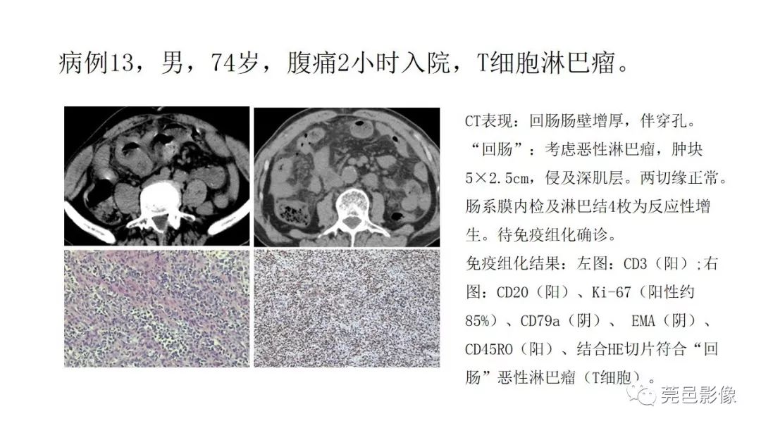 【PPT】肠道淋巴瘤CT诊断