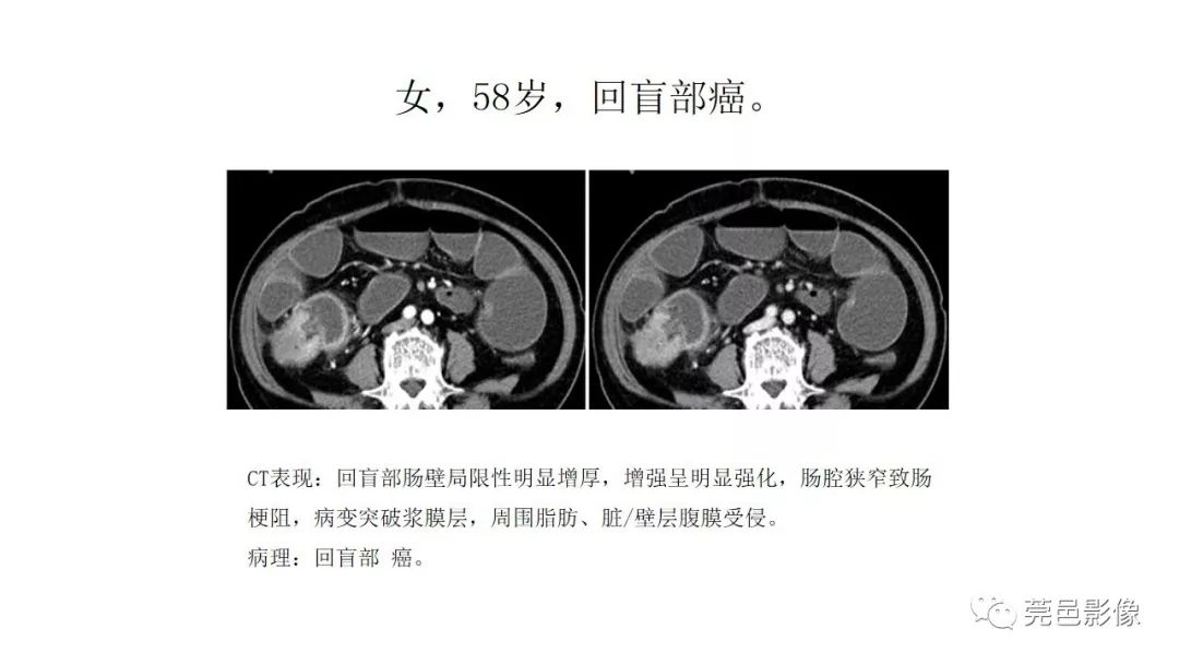 【PPT】肠道淋巴瘤CT诊断