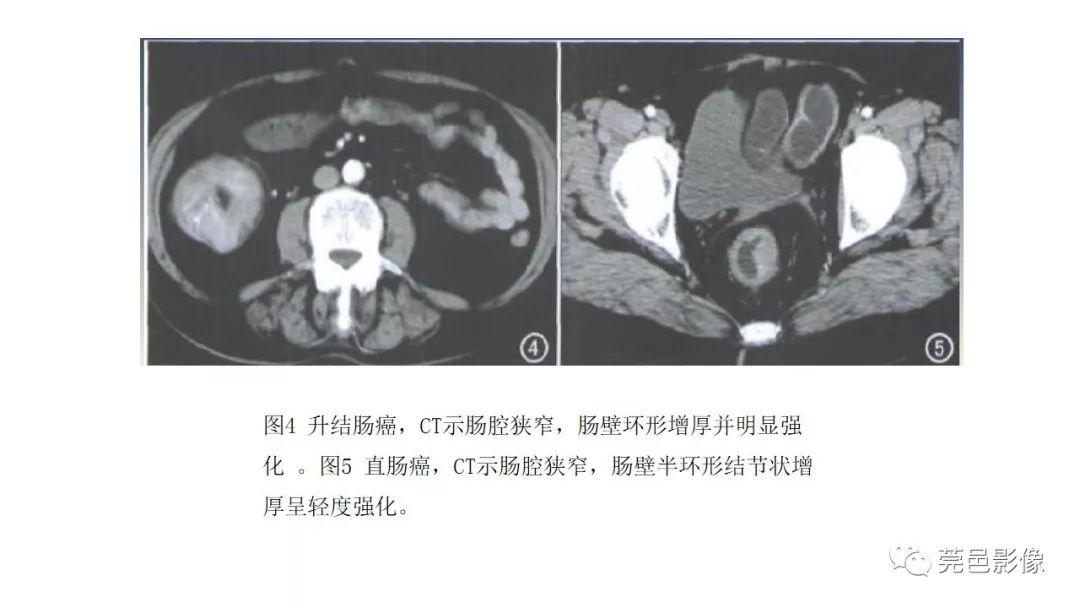 【PPT】肠道淋巴瘤CT诊断