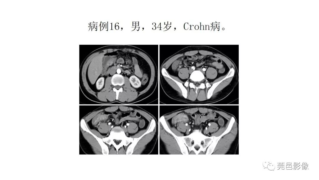 【PPT】肠道淋巴瘤CT诊断