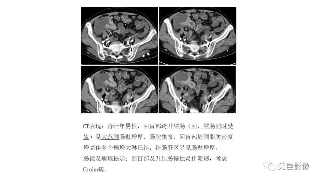 【PPT】肠道淋巴瘤CT诊断