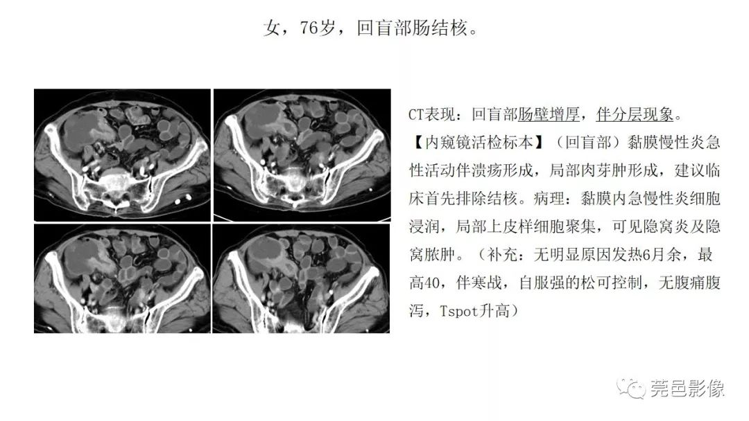 【PPT】肠道淋巴瘤CT诊断