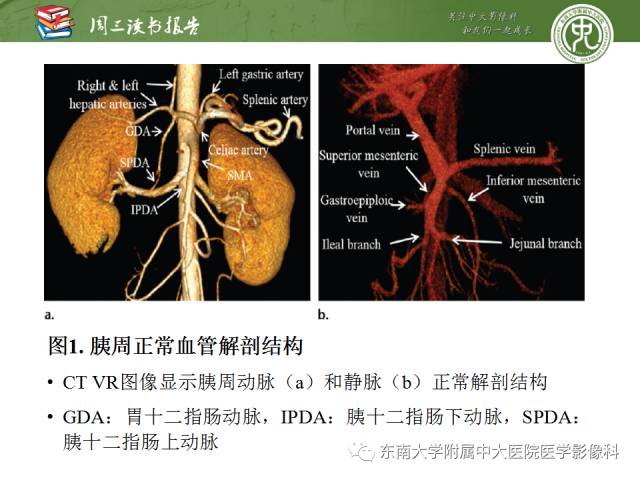 【PPT】多排螺旋CT评价胰腺导管腺癌中肿瘤与血管的关系：不同分期系统及其对治疗的影响