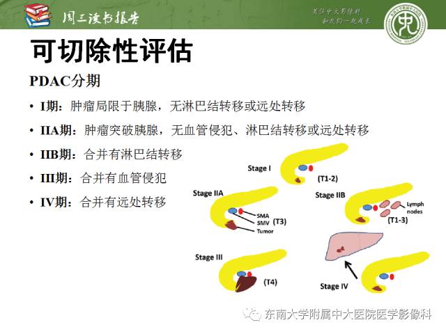 【PPT】多排螺旋CT评价胰腺导管腺癌中肿瘤与血管的关系：不同分期系统及其对治疗的影响