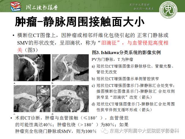 【PPT】多排螺旋CT评价胰腺导管腺癌中肿瘤与血管的关系：不同分期系统及其对治疗的影响