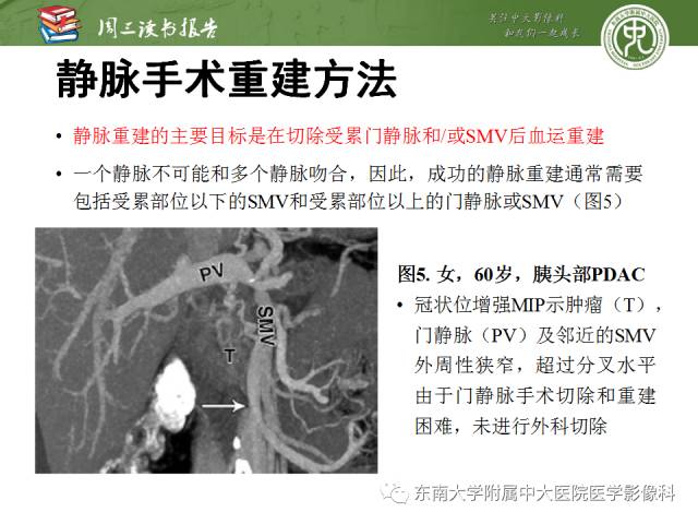 【PPT】多排螺旋CT评价胰腺导管腺癌中肿瘤与血管的关系：不同分期系统及其对治疗的影响