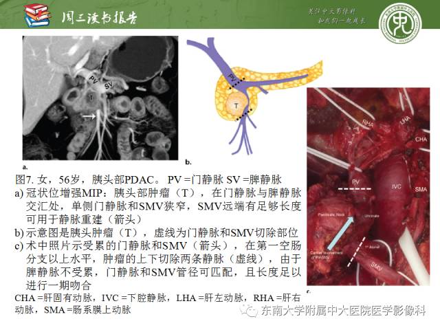 【PPT】多排螺旋CT评价胰腺导管腺癌中肿瘤与血管的关系：不同分期系统及其对治疗的影响