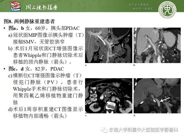 【PPT】多排螺旋CT评价胰腺导管腺癌中肿瘤与血管的关系：不同分期系统及其对治疗的影响