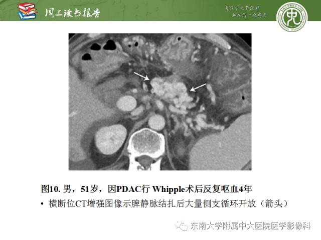 【PPT】多排螺旋CT评价胰腺导管腺癌中肿瘤与血管的关系：不同分期系统及其对治疗的影响