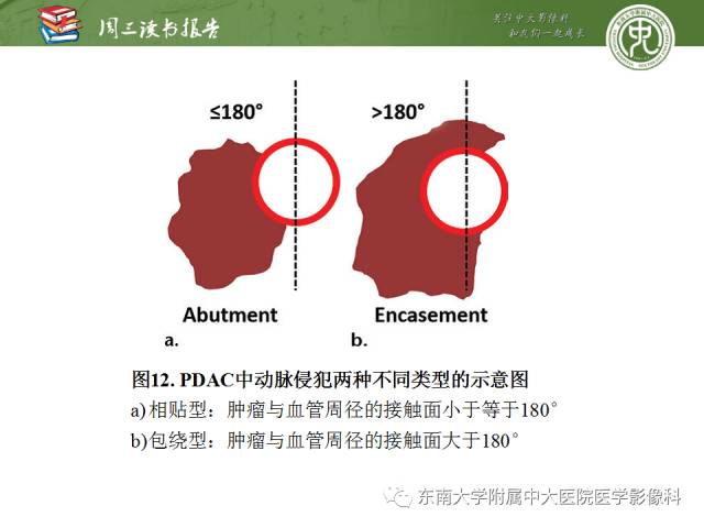 【PPT】多排螺旋CT评价胰腺导管腺癌中肿瘤与血管的关系：不同分期系统及其对治疗的影响