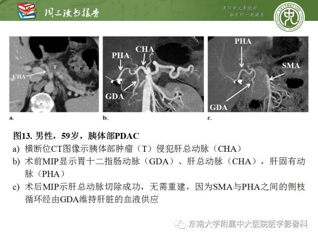 【PPT】多排螺旋CT评价胰腺导管腺癌中肿瘤与血管的关系：不同分期系统及其对治疗的影响