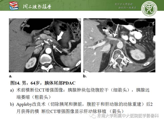 【PPT】多排螺旋CT评价胰腺导管腺癌中肿瘤与血管的关系：不同分期系统及其对治疗的影响