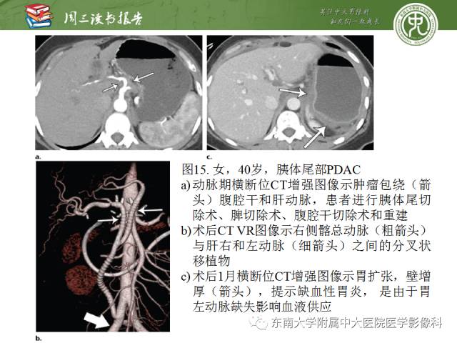 【PPT】多排螺旋CT评价胰腺导管腺癌中肿瘤与血管的关系：不同分期系统及其对治疗的影响