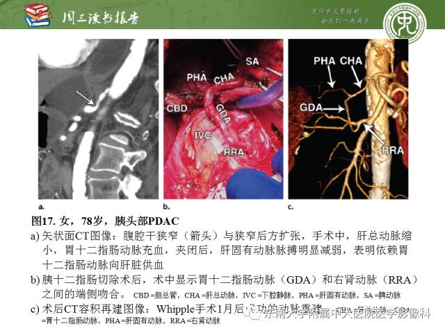 【PPT】多排螺旋CT评价胰腺导管腺癌中肿瘤与血管的关系：不同分期系统及其对治疗的影响