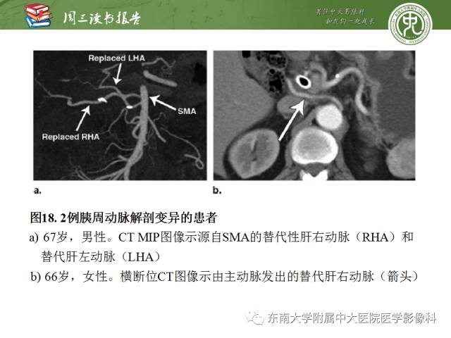 【PPT】多排螺旋CT评价胰腺导管腺癌中肿瘤与血管的关系：不同分期系统及其对治疗的影响