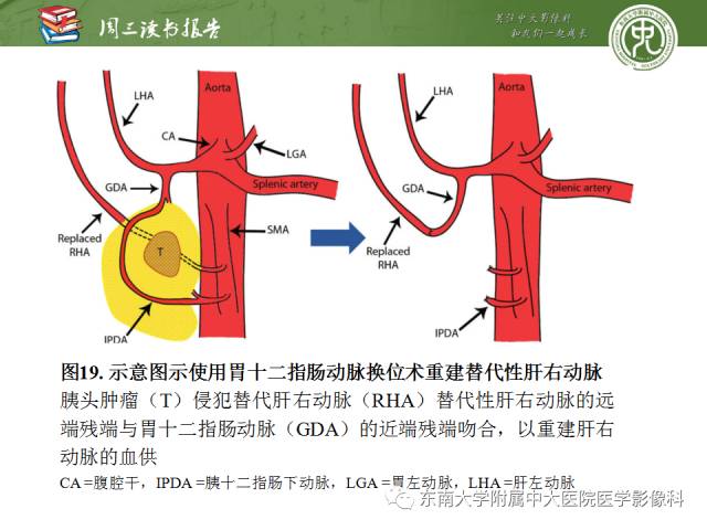 【PPT】多排螺旋CT评价胰腺导管腺癌中肿瘤与血管的关系：不同分期系统及其对治疗的影响