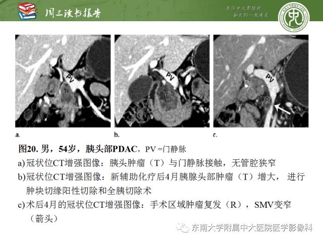 【PPT】多排螺旋CT评价胰腺导管腺癌中肿瘤与血管的关系：不同分期系统及其对治疗的影响