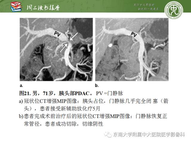 【PPT】多排螺旋CT评价胰腺导管腺癌中肿瘤与血管的关系：不同分期系统及其对治疗的影响