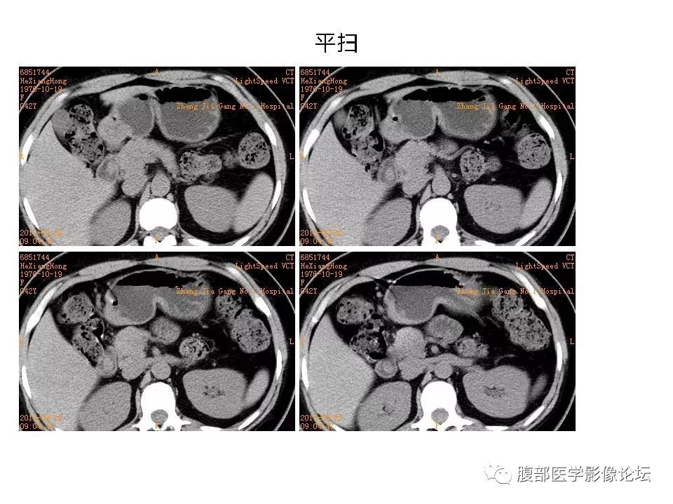 【病例】十二指肠布氏腺错构瘤1例CT影像