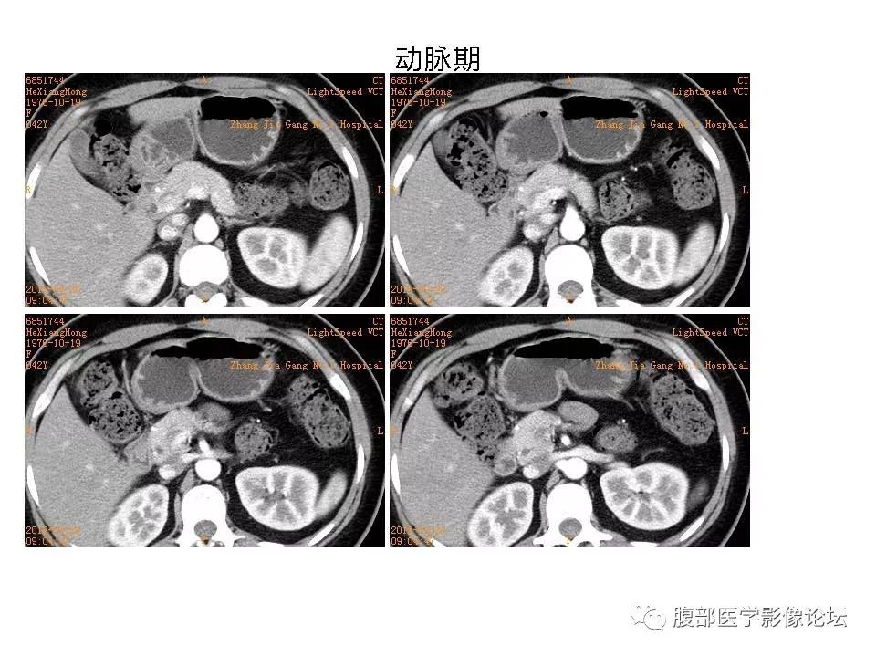 【病例】十二指肠布氏腺错构瘤1例CT影像