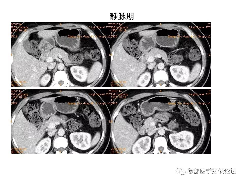 【病例】十二指肠布氏腺错构瘤1例CT影像