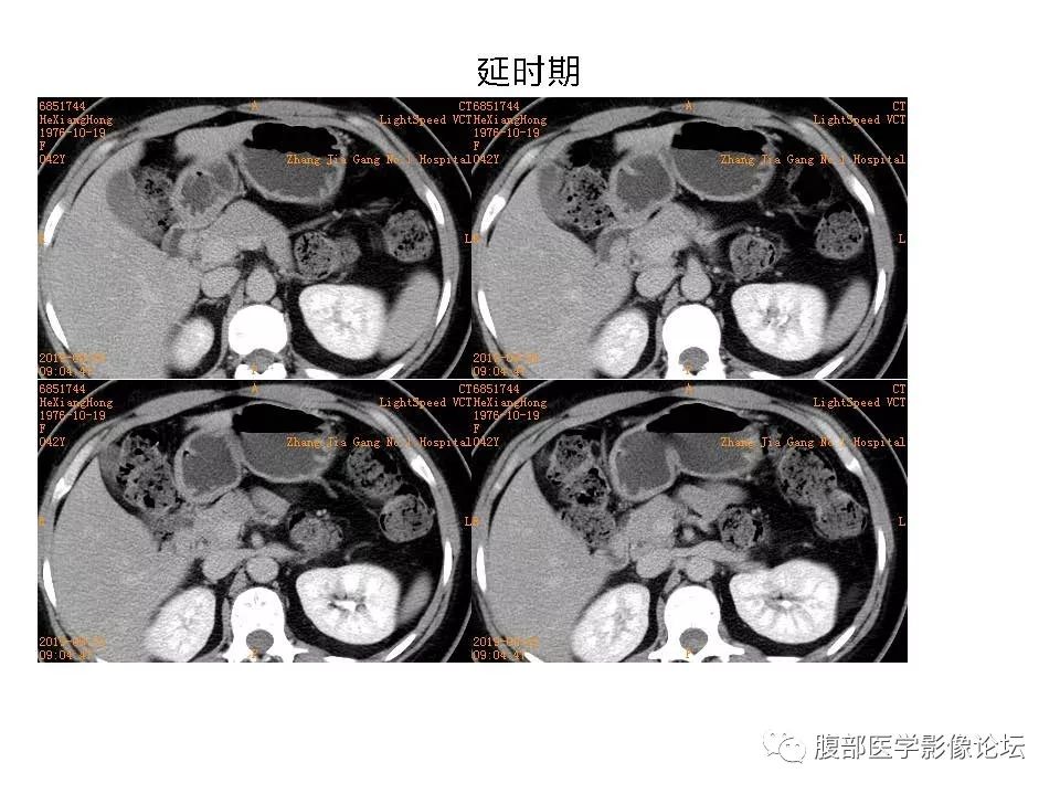 【病例】十二指肠布氏腺错构瘤1例CT影像